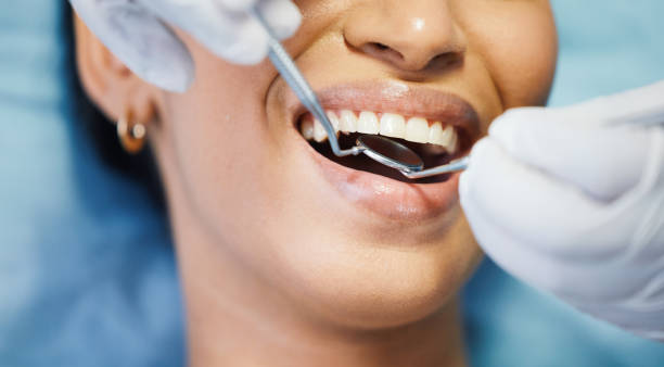 Best Emergency Wisdom Teeth Removal in Lifornia Polytechnic State University, CA