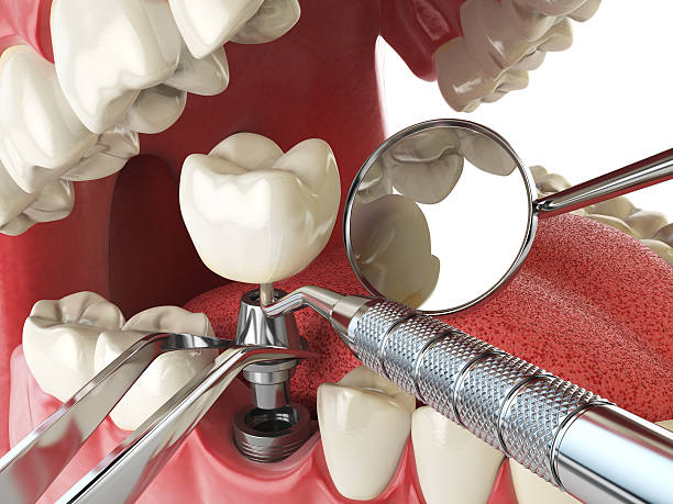 Best Same-Day Emergency Dentist in Lifornia Polytechnic State University, CA